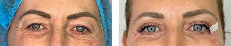 Augenlidstraffung Vorher Nachher