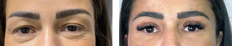 Schlupflider entfernen vorher nachher