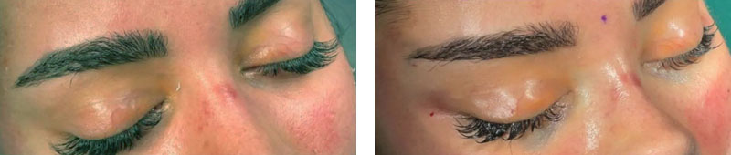 Schläfenlifting Temporal Lifting Vorher-Nachher Bilder Schläfenlifting Temporal Lifting Vorher-Nachher Bilder