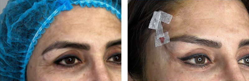 Temporal Lifting Vorher-Nachher Bilder Temporal Lifting Vorher-Nachher Bilder