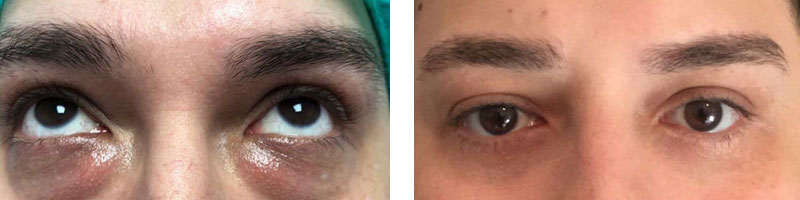 Unterlidstraffung Vorher-Nachher Bilder