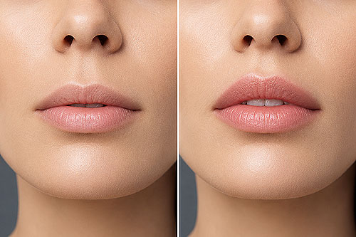 Lip_lift_bullhorn_lift_mannheim_heilbronn_aplus Lip_lift_bullhorn_lift_mannheim_heilbronn_aplus